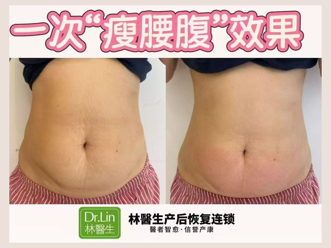 身材管理科部客户案例:一次瘦腰腹效果