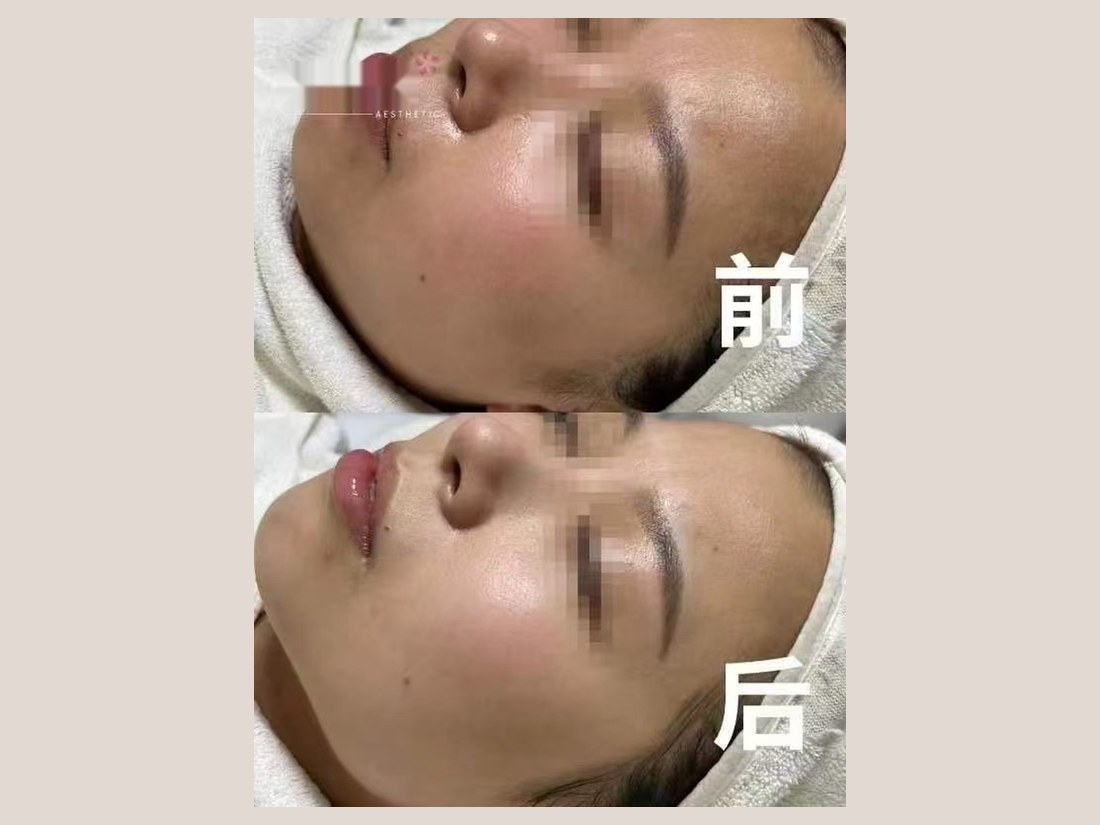 科技美肤部客户案例:面部状态对比