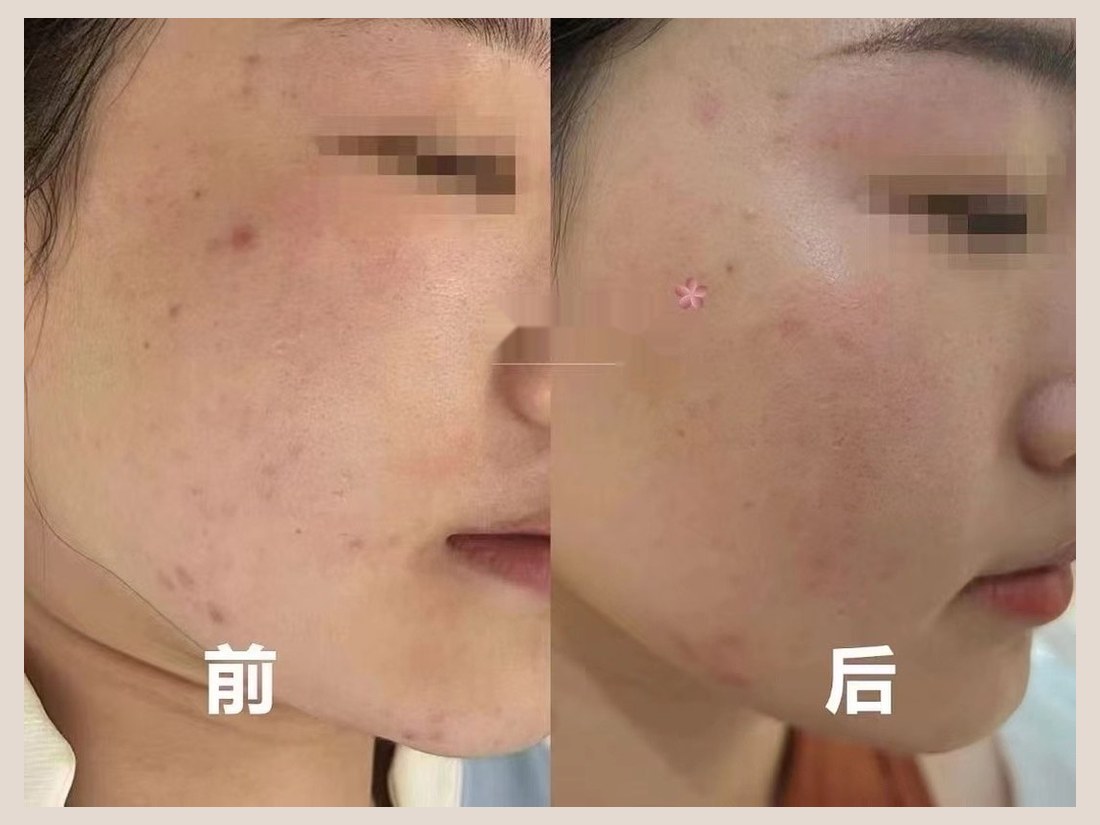 科技美肤部客户案例:面部状态对比
