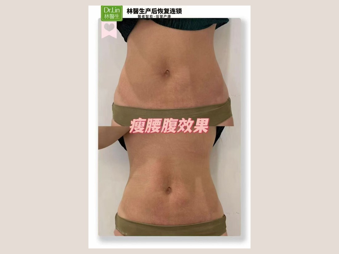 身材管理科部客户案例:瘦腰腹效果