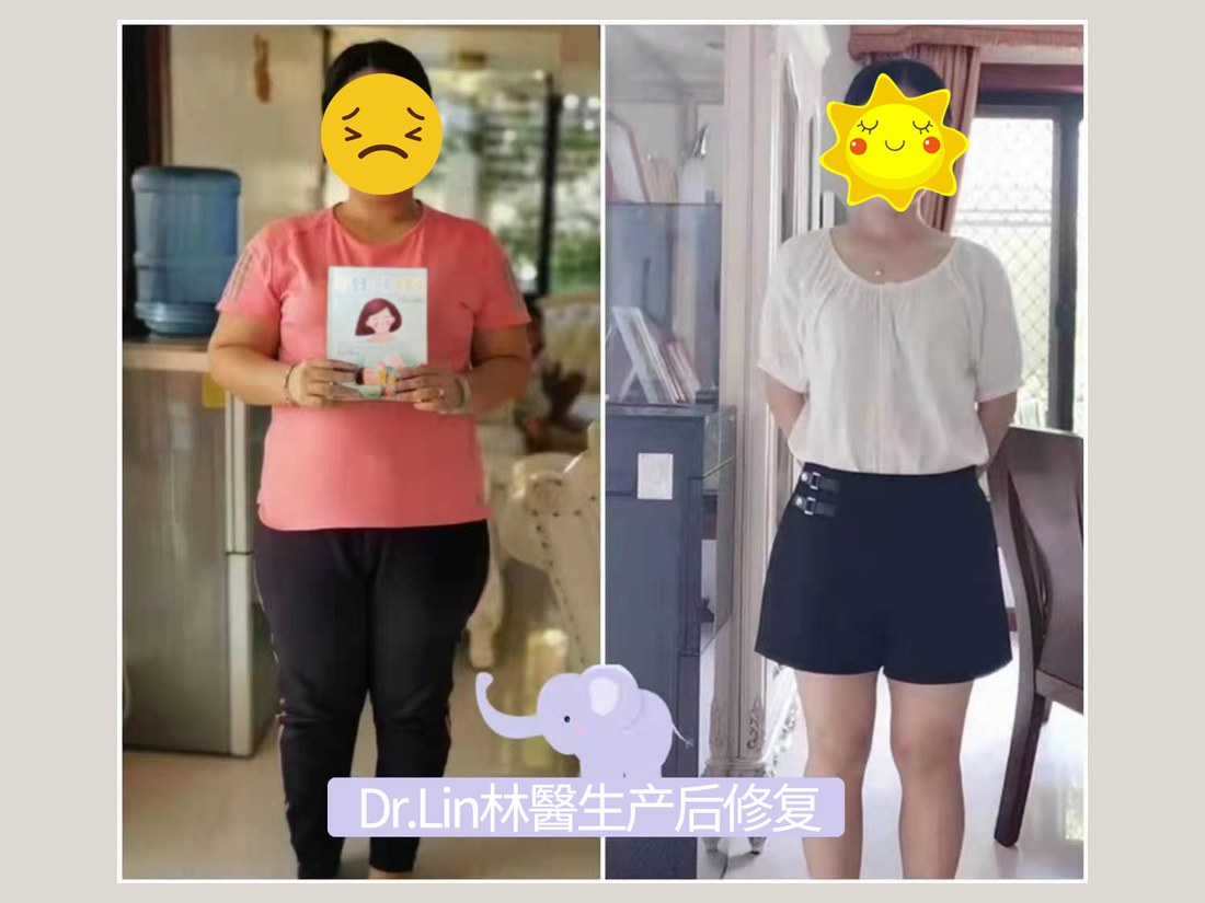 身材管理科部客户案例:产后体型调理前后对照