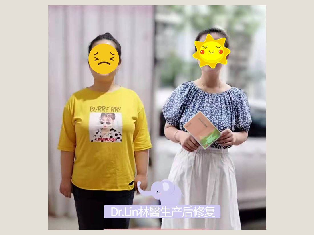 身材管理科部客户案例:产后体型调理前后对照