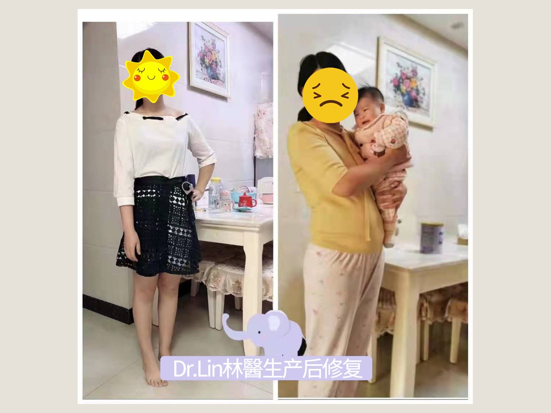 身材管理科部客户案例:产后体型调理前后对照