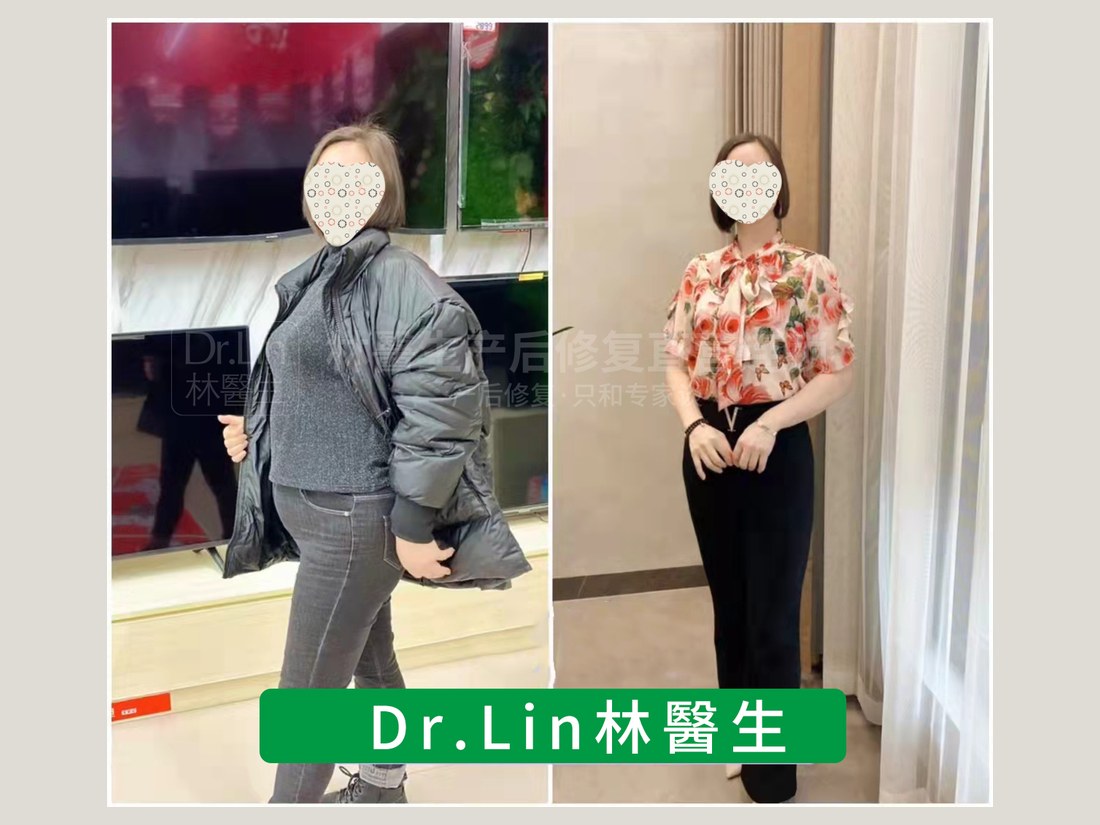 身材管理科部客户案例:产后体型调理前后对照