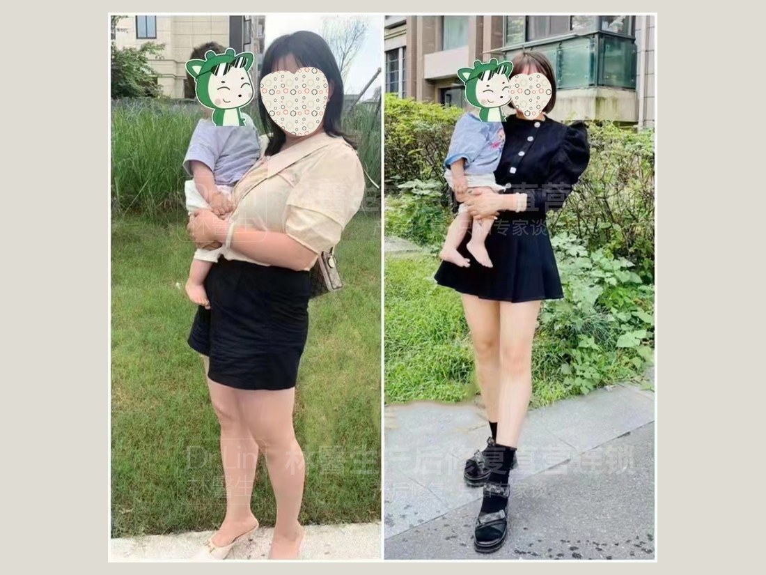 身材管理科部客户案例:抱娃体型前后对照