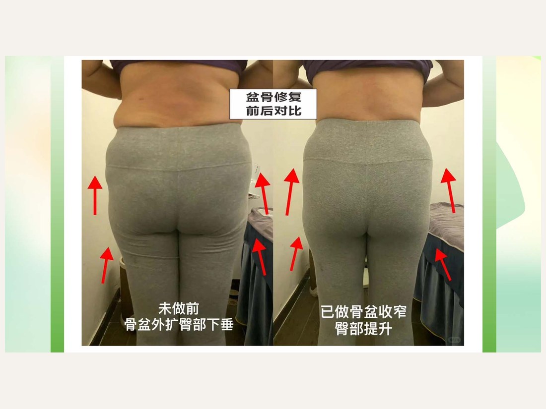骨龄抗衰科部客户案例:黄金五步骨盆修复