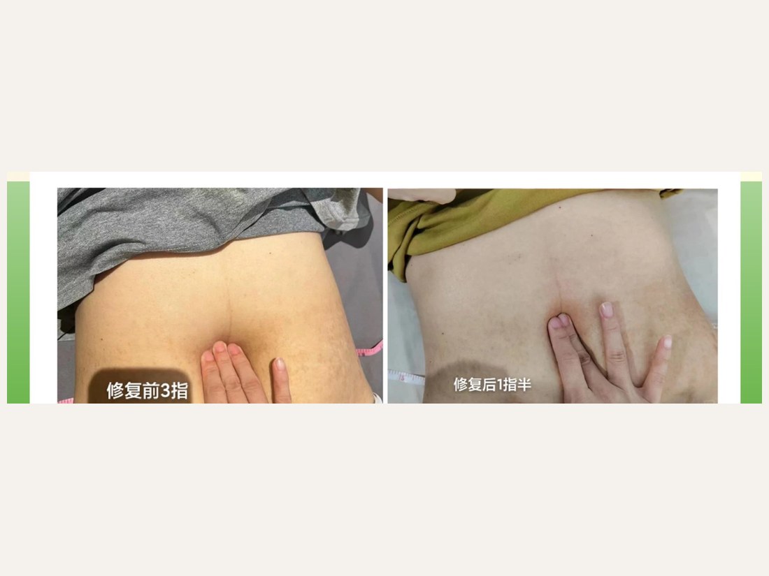 身材管理科部客户案例:腹直肌分离修复