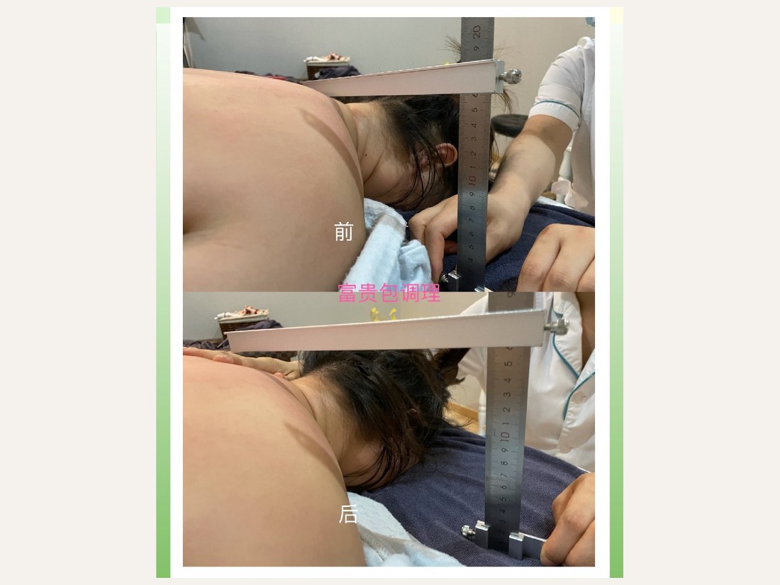 中医调理部客户案例:富贵包调理