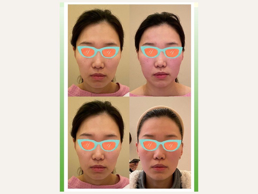 骨龄抗衰科部客户案例:面部骨龄抗衰