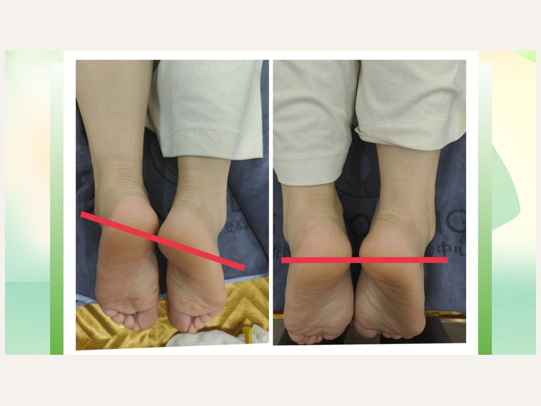骨龄抗衰科部客户案例:骨盆修复 · 长短腿
