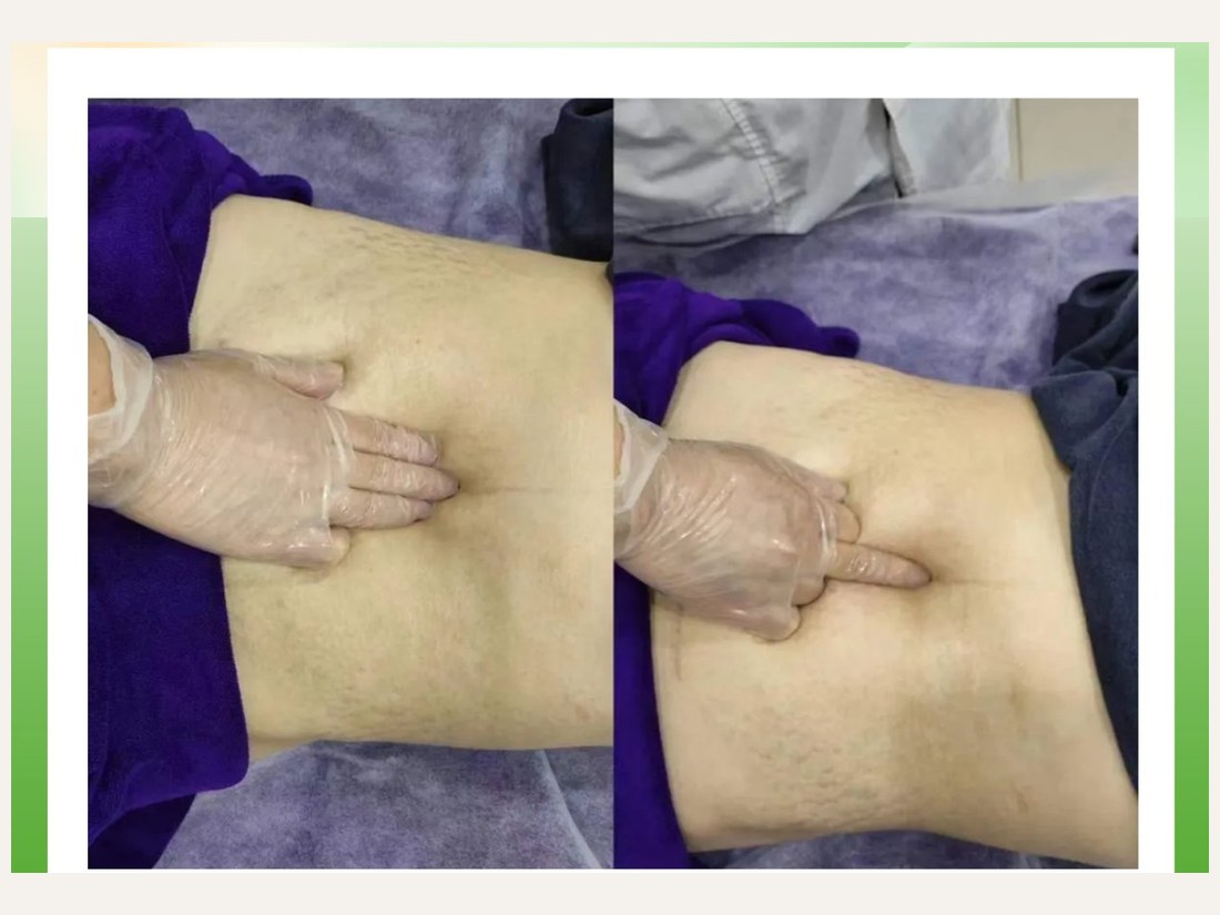 身材管理科部客户案例:腹直肌修复手法记录