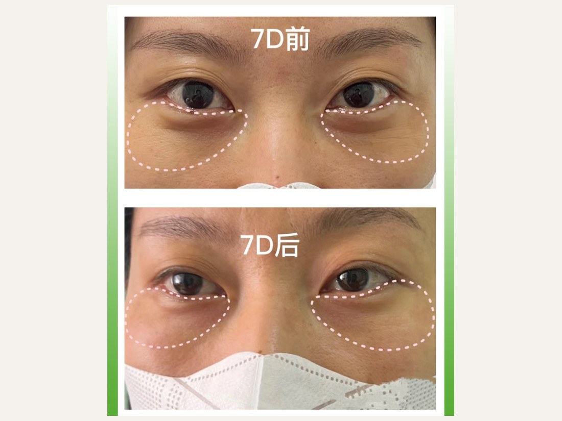 科技美肤部客户案例:7D 聚拉提
