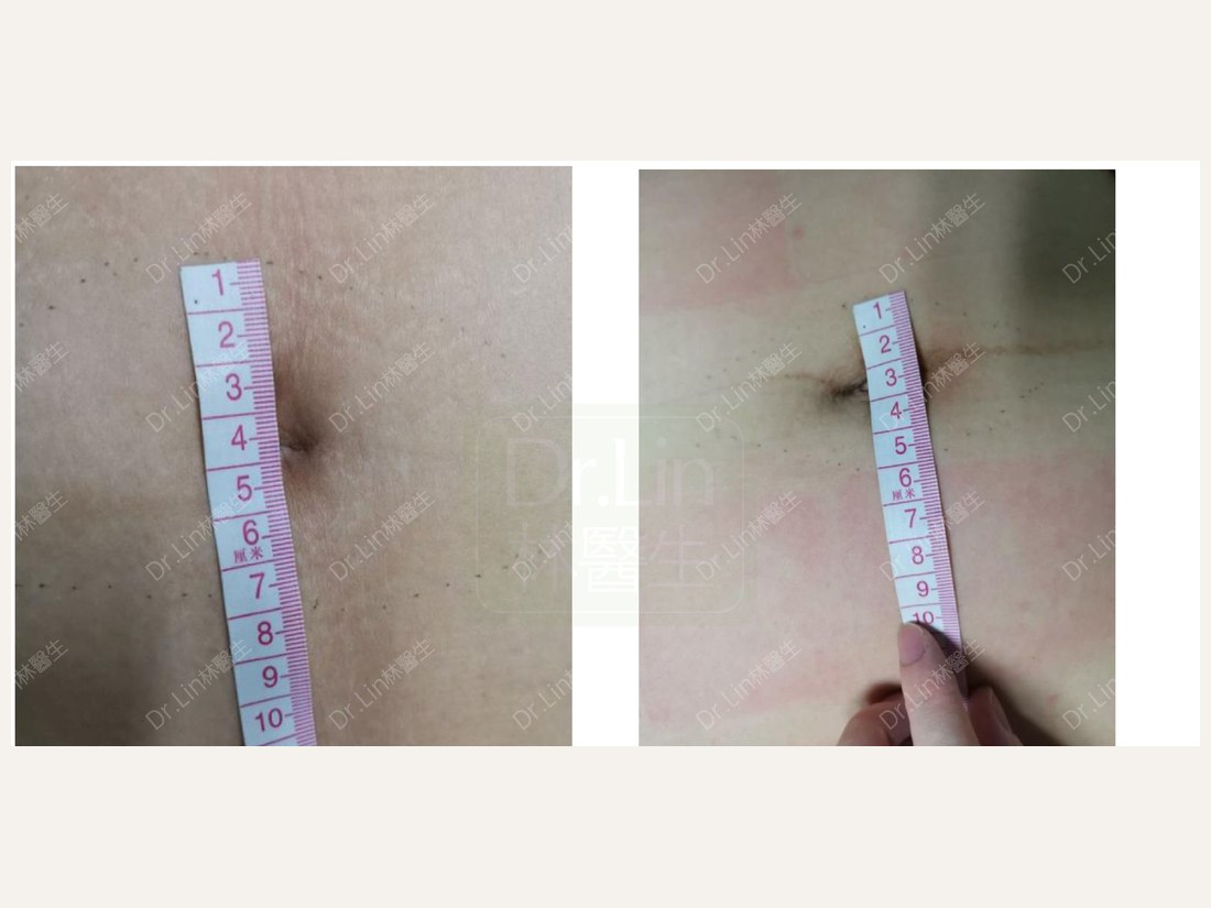 科技美肤部客户案例:妊娠纹 7cm → 5cm