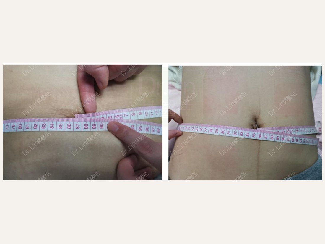身材管理科部客户案例:腰围 87 → 85cm