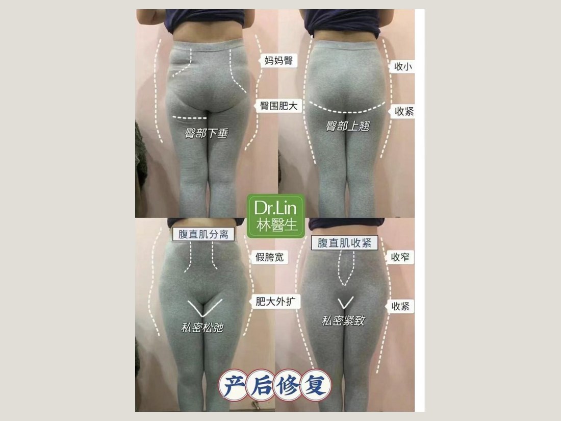 身材管理科部客户案例:产后修复综合对照