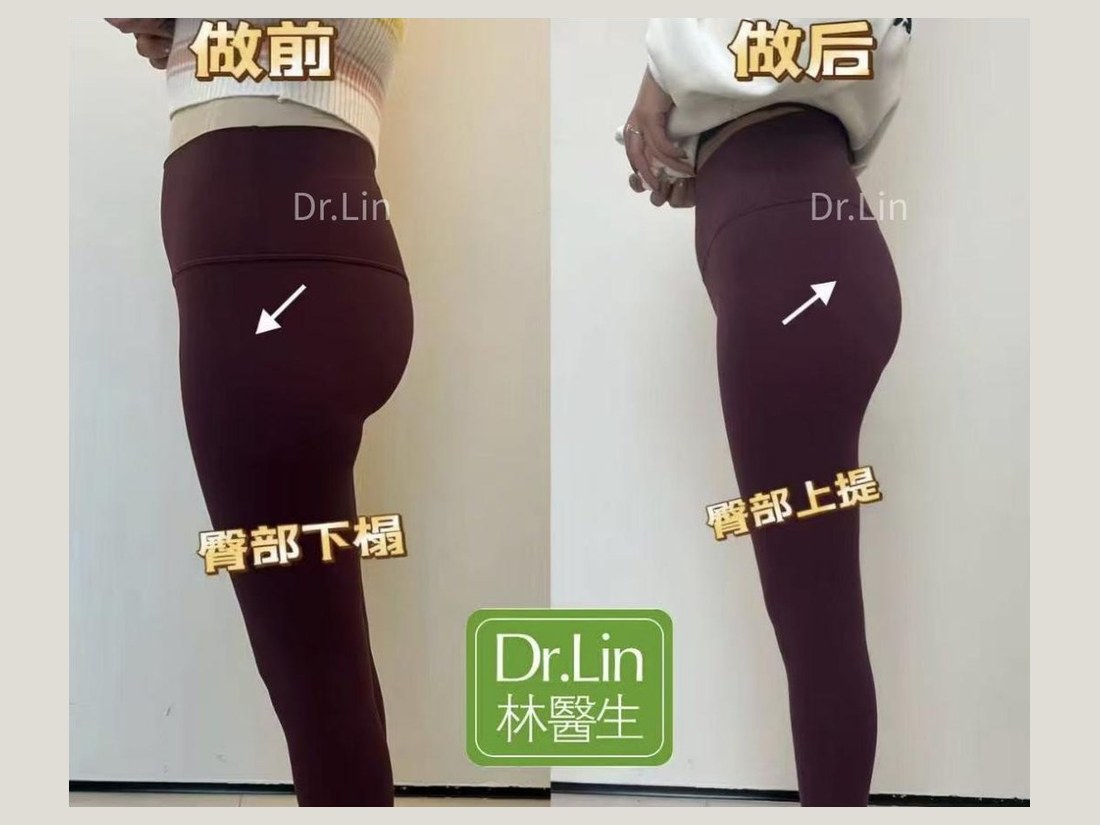 身材管理科部客户案例:臀部上提