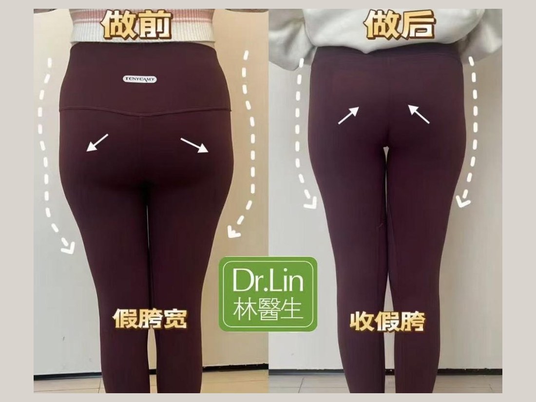 身材管理科部客户案例:收假胯