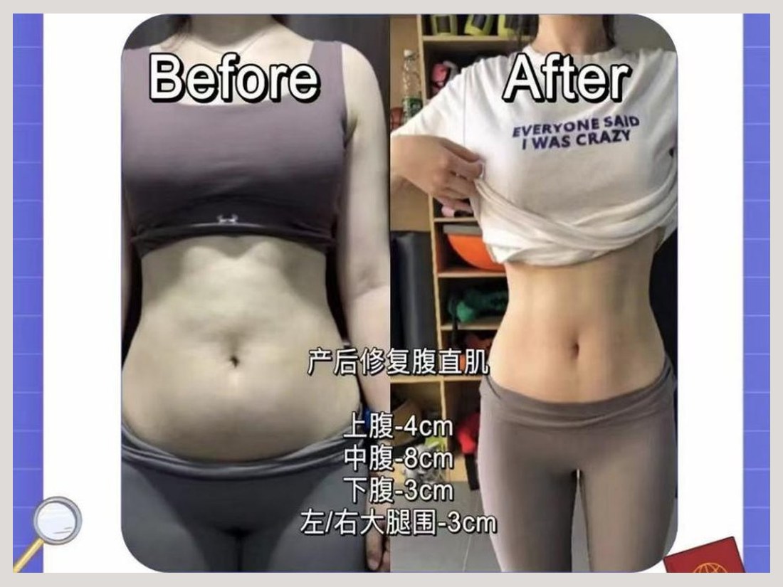 骨龄抗衰科部客户案例:腹直肌修复前后对比