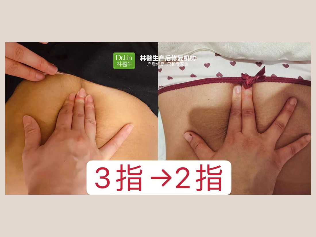 身材管理科部客户案例:腹直肌修复 3 指 → 2 指