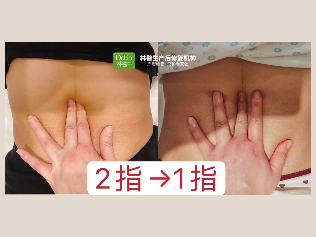 身材管理科部客户案例:腹直肌修复 2 指 → 1 指