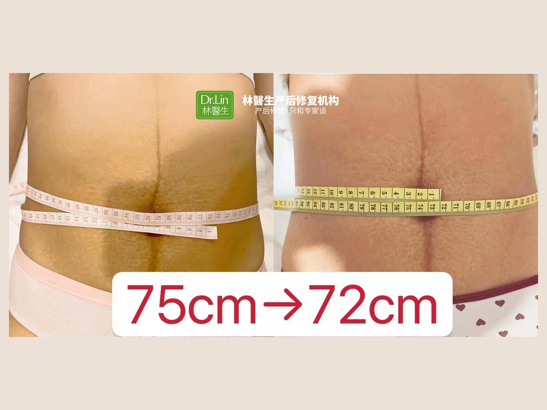 身材管理科部客户案例:腰围 75cm → 72cm