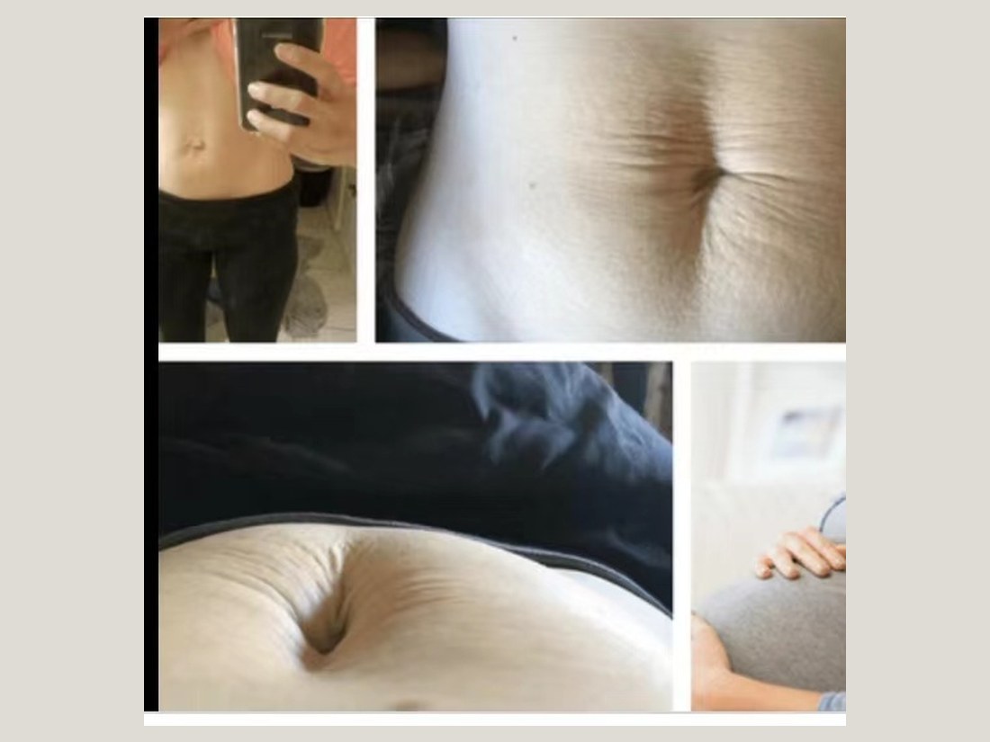 身材管理科部客户案例:腹直肌局部对照