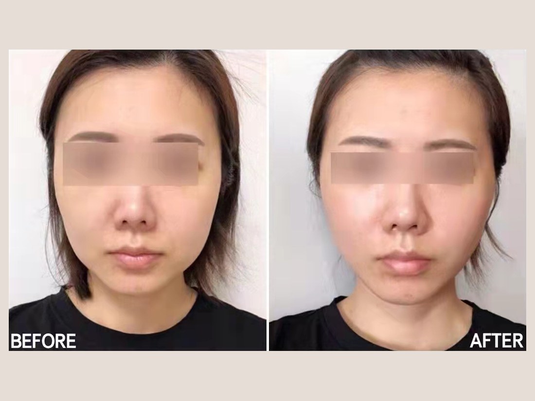 科技美肤部客户案例:面部状态对比