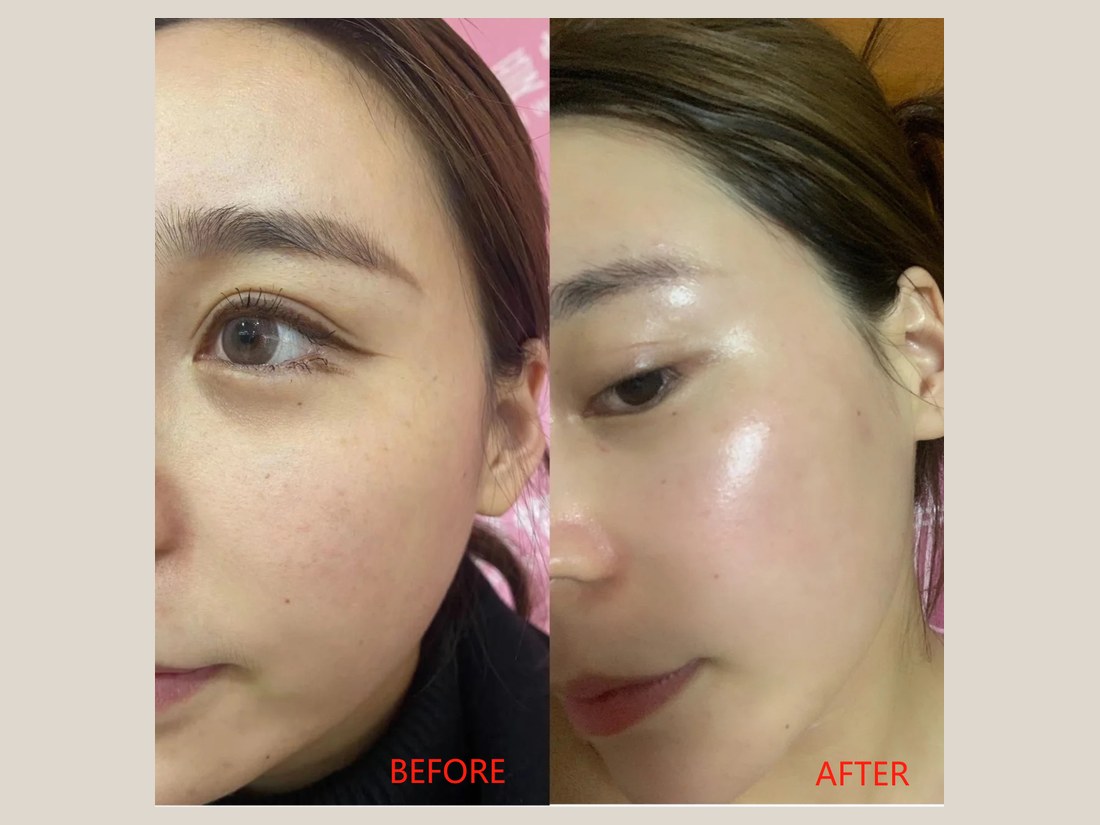 科技美肤部客户案例:眼周状态对比