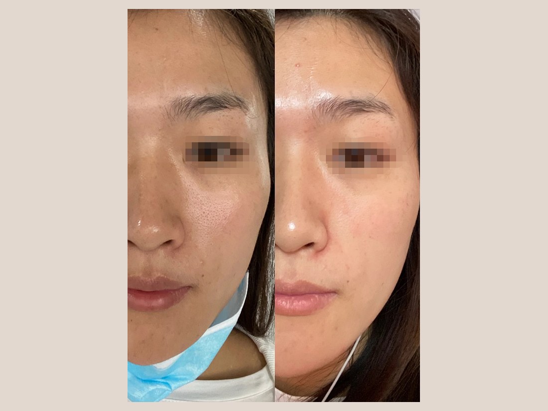 科技美肤部客户案例:眼周状态对比