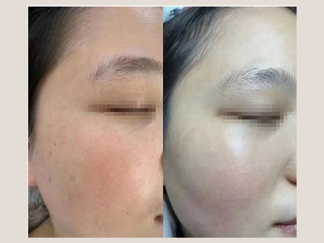 科技美肤部客户案例:眼周细节对照