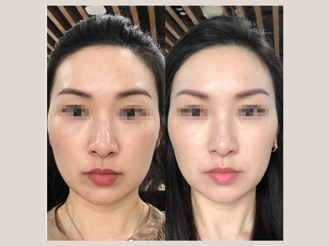 科技美肤部客户案例:面部轮廓对比